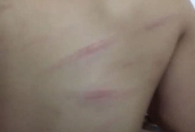 Tin nóng giáo dục: Không chép bài, bé lớp 1 bị cô giáo đánh bầm lưng Nhiều vết thương trên lưng em Ng. được gia đình phát hiện