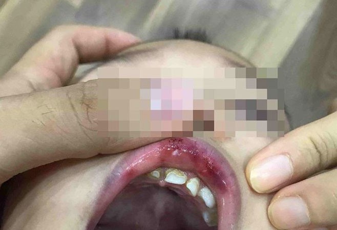 Điểm nhấn giáo dục: Cô giáo ở Hà Nội tát trẻ bầm dập, tụ máu môi Điểm nhấn giáo dục: Cô giáo ở Hà Nội tát trẻ bầm dập, tụ máu môi
