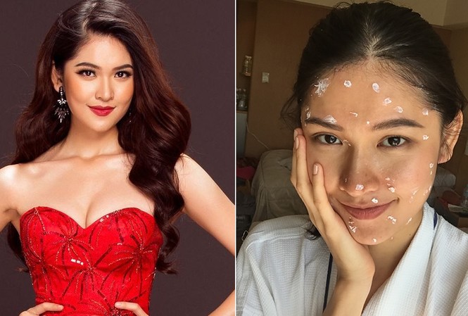 Thùy Dung bất ngờ bị thuỷ đậu trước thềm chung kết Miss International Tuy bị thuỷ đậu nhưng người đẹp vẫn rất lạc quan.
