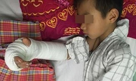 Đùa nghịch, anh họ chém gần đứt lìa tay bé 8 tuổi Cháu T.D.L. Ảnh: Sức khỏe đời sống.