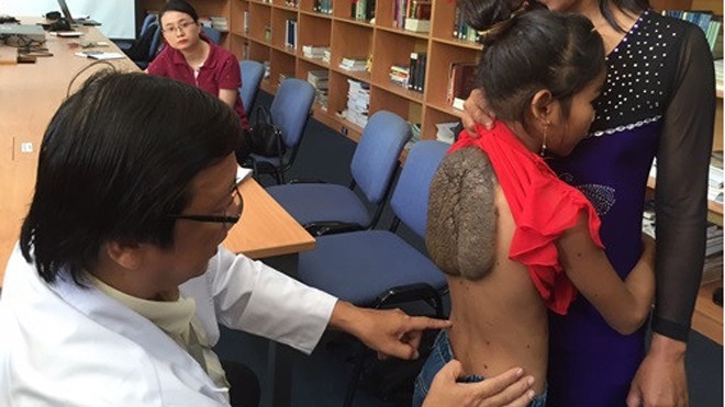 'Cô bé mai rùa' mơ thành cô giáo “Cô bé mai rùa” trước khi được phẫu thuật. Ảnh: Quốc Ngọc