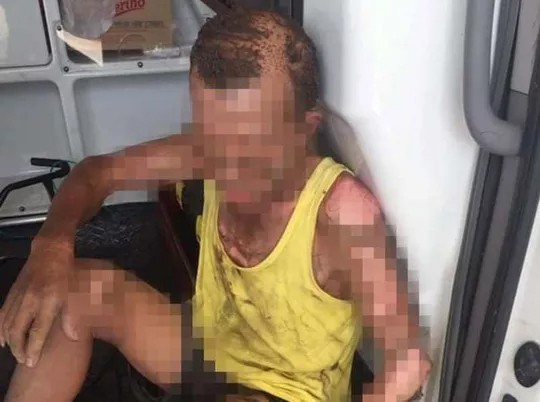 Con trai đổ xăng lên người chính mình và bố đẻ châm lửa thiêu Ông P. bị bỏng toàn thân đang được cấp cứu tại bệnh viện