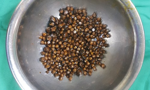 400 viên sỏi ken chặt trong túi mật bệnh nhân nữ 60 tuổi Số sỏi bác sĩ lấy ra từ túi mật của bệnh nhân 60 tuổi
ảnh: TH