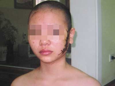 Cô gái bị xăm hình 'quái vật' lên mặt từng định quyên sinh Cô gái bị xăm hình 'quái vật' lên mặt từng định quyên sinh
