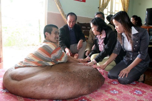 Câu chuyện kỳ lạ của người 'chân voi' vừa qua đời Câu chuyện kỳ lạ của người 'chân voi' vừa qua đời