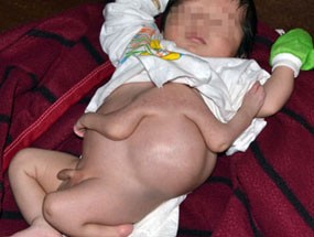 Em bé mới sinh có bốn cánh tay Em bé mới sinh có bốn cánh tay
