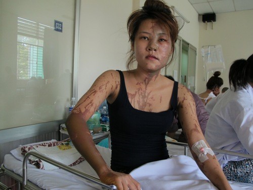 Nữ lễ tân nhà hàng bị tạt axit dã man Nữ lễ tân nhà hàng bị tạt axit dã man