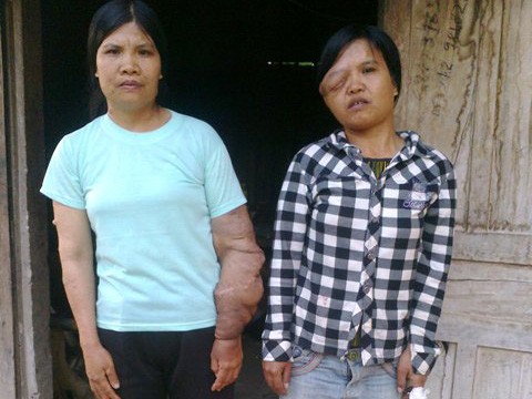 Nỗi đau chị em mang thân hình 'quỷ ám' Nỗi đau chị em mang thân hình 'quỷ ám'