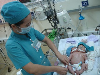 Bé gái hai đầu đã tử vong Cặp song sinh dính liền đã không thể tiếp tục sự sống - Ảnh do bệnh viện cung cấp