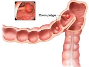 Phát hiện gen đột biến có thể ngăn di căn ung thư Phát hiện gen đột biến có thể ngăn di căn ung thư