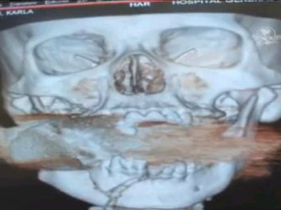 Bị lựu đạn găm vào má không chết Bị lựu đạn găm vào má không chết