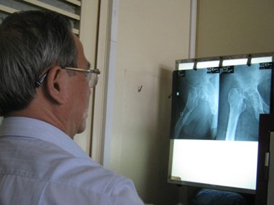 Mục hai khớp háng vì đắp thuốc ‘lang băm’ Mục hai khớp háng vì đắp thuốc ‘lang băm’