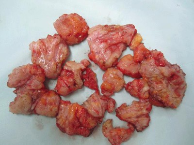 Nam nhi suýt chết vì bơm ngực, độn mông Nam nhi suýt chết vì bơm ngực, độn mông