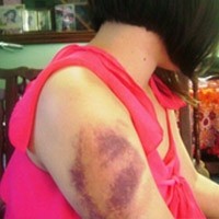Nữ sinh bị cha bạo hành phải nhập viện Nữ sinh bị cha bạo hành phải nhập viện
