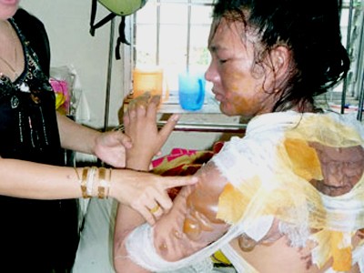 Chồng tạt nước sôi lên vợ vì bị đòi ly dị Chồng tạt nước sôi lên vợ vì bị đòi ly dị