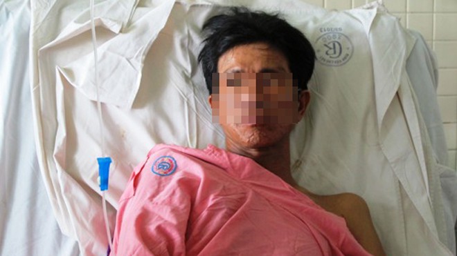 Suýt chết vì hóc xương gà Sức khỏe bệnh nhân T. đã hồi phục