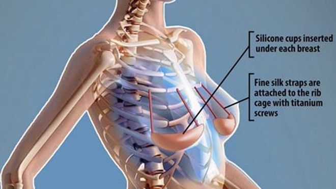 Áo nâng ngực mặc… dưới da Áo nâng ngực dưới da cấu tạo gồm một quả áo ngực bằng silicon loại tốt, ở dạng rắn đặt dưới mô vú và các dây đeo bằng lụa gắn cố định vào xương sườn của bệnh nhân để nâng đỡ bầu ngực. Ảnh: Daily Mail