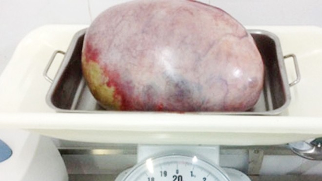 Cô gái mang khối u buồng trứng to như quả dừa Khối u buồng trứng nặng gần 5 kg trong bụng thiếu nữ. Ảnh: Đ.X.