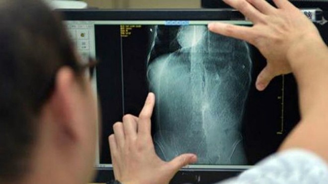 10 năm táo bón do phình đại tràng Ảnh: Mirror.