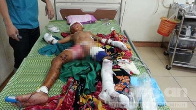 Đồ chơi phát nổ, bé 9 tuổi bị chấn thương nặng Hiện sức khỏe của cháu đang được theo dõi đặc biệt tại bệnh viện. Ảnh: Công an TP.HCM
