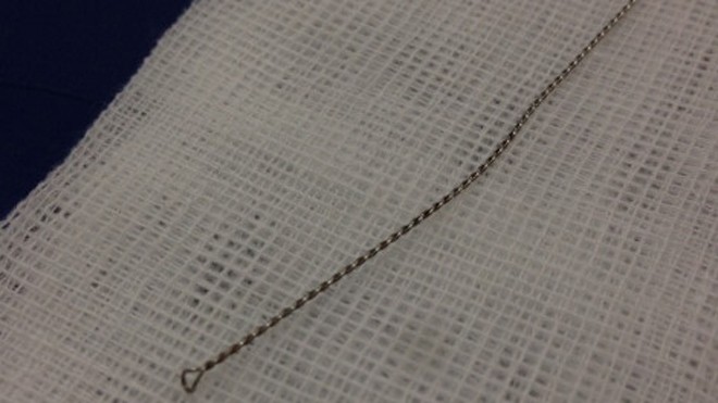 Thợ cắt tóc để 'quên' cây móc ráy trong tai khách hàng Chiếc móc lấy ra từ tai bệnh nhân. Ảnh: Sơn Tùng/PLO