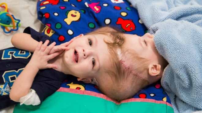 Ca mổ dài 27 giờ tách rời đôi song sinh dính liền đầu Jadon và Anias trước ca phẫu thuật. Ảnh: CNN.