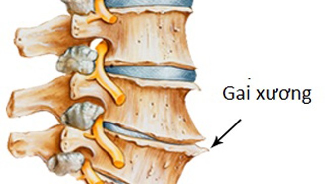 Gai cột sống và những quan niệm sai lầm trong điều trị Thoái hóa đĩa đệm cột sống là một nguyên nhân hình thành gai xương cột sống