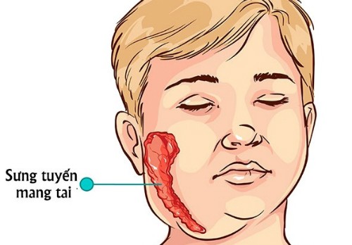 Nhận biết và xử trí khi mắc bệnh quai bị Biểu hiện thường gặp của bệnh quai bị là sưng tuyến mang tai. Ảnh: cdc.