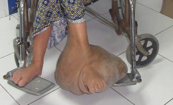 Cắt khối u nặng 10kg ở bàn chân bệnh nhân Sau 6 giờ phẫu thuật, ê kíp đã lấy được khối u nặng gần 10kg.
