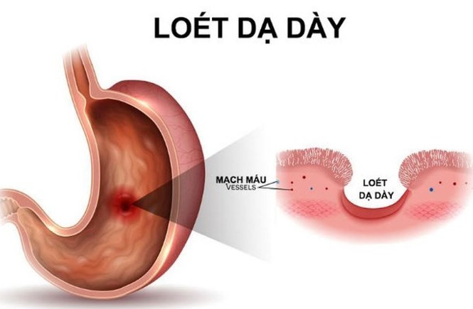 Ăn kiêng đúng cách cho người bị loét dạ dày Ăn kiêng đúng cách cho người bị loét dạ dày