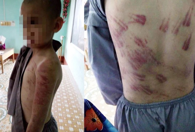 Lãnh đạo huyện Hà Trung lên tiếng vụ học sinh tiểu học bị đánh bầm tím Lãnh đạo huyện Hà Trung lên tiếng vụ học sinh tiểu học bị đánh bầm tím