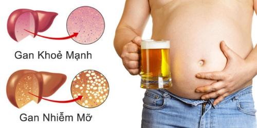 Bị gan nhiễm mỡ phải làm sao? Ảnh minh hoạ: Internet