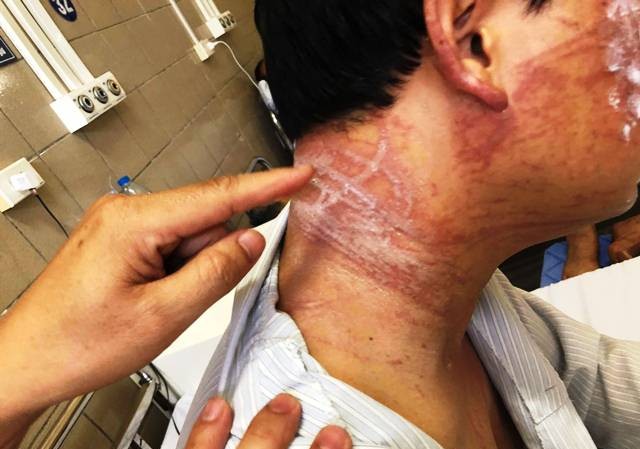 Tắm biển, người đàn ông nhập viện cấp cứu vì sứa cắn Các vết thương vẫn chằng chịt trên cơ thể người đàn ông sau 10 ngày bị sứa tấn công.