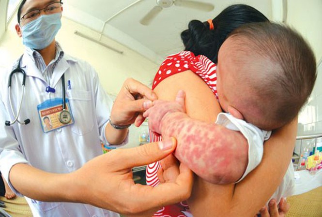 56 tỉnh thành có ca mắc sởi - Dịch đang diễn biến phức tạp Ban sởi mọc theo thứ tự bắt đầu ngày thứ nhất từ đầu, mặt, cổ. Ngày thứ 2 mọc ở ngực lưng, cánh tay. Ngày thứ 3 mọc ở bụng, mông, đùi, chân. Khi ban mọc tới chân hết sốt và ban bắt đầu bay. Ảnh: Internet