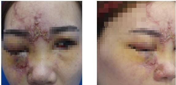 Thiếu nữ phải múc bỏ mắt vì tiêm chất làm đầy để nâng mũi Bệnh nhân với những tổn thương ở mắt không thể phục hồi. Ảnh BV cung cấp