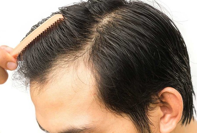 Chi 200 triệu cấy tóc chữa hói, quý ông Hà Nội lĩnh hàng trăm ổ sẹo trên đầu Ảnh minh hoạ: Internet