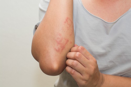 Những dấu hiệu 'vặt vãnh' này cảnh báo ung thư gan đang 'trú' trong người bạn Ngứa cũng có thể là một trong những dấu hiệu sớm của bệnh ung thư gan. Ảnh minh họa: Internet