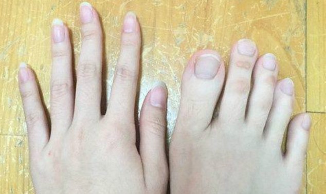 Nữ sinh bất ngờ nổi tiếng vì 'ngón chân dài... như ngón tay' Ngón chân của cô gái khá dài.