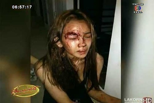Sao nữ Thái Lan trầm cảm sau khi suýt bị thợ xây cưỡng bức Nữ ca sĩ bị thương tích sau vụ đột nhập. Ảnh: Lakorn.