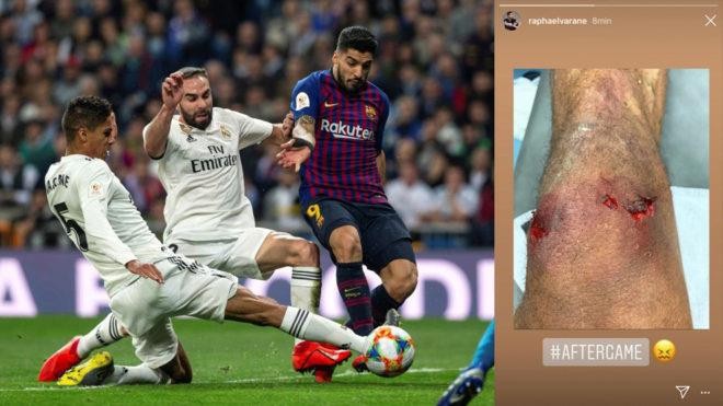 Real nhận tin dữ trước thềm Siêu kinh điển với Barca Varane nguy cơ lỡ El Clasico ở vòng 26 La Liga vì chấn thương.