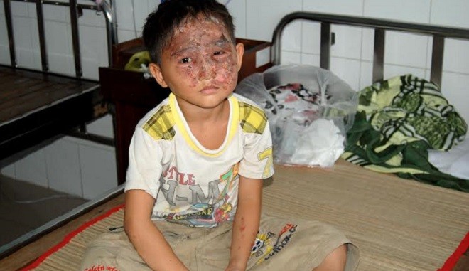 Bé trai bị bỏng khắp mặt khi chơi lồng đèn trung thu Cháu Nguyễn Hoàng Huy đang được điều trị tại bệnh viện đa khoa trung tâm tỉnh Tiền Giang
