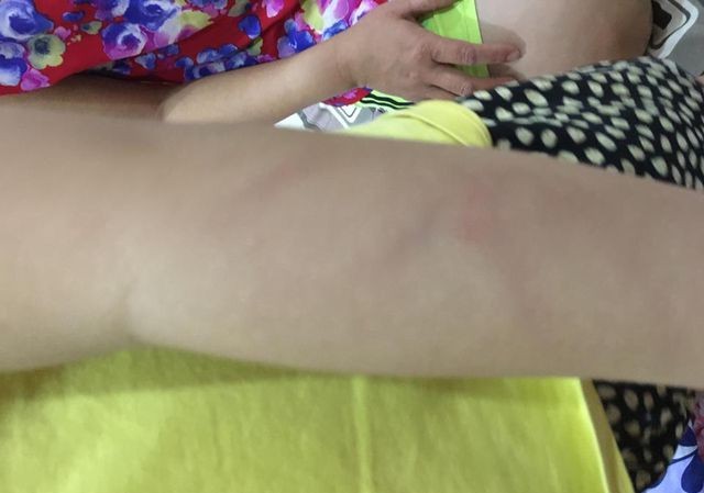 Đòi bồi thường 100 triệu 'bất thành', phụ huynh muốn kiện trường Hình ảnh bé P được cho là bị đánh trày xước người.