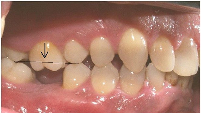 Trồng răng cấm giá bao nhiêu là chuẩn nhất? Mất răng cấm cần được trồng lại răng giả sớm