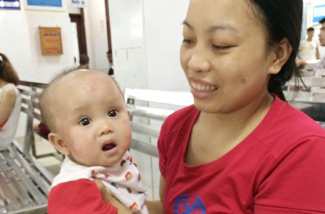 Nhiều người bệnh nặng vì nắng nóng Bệnh nhi Khánh Vy bị viêm da cơ địa. Ảnh T.Hà