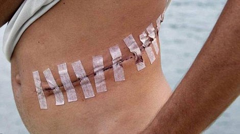 Bên trong 'bệnh viện' lấy nội tạng người của IS Một nạn nhân sau khi bị IS mổ lấy gan nhưng may mắn sống sót.