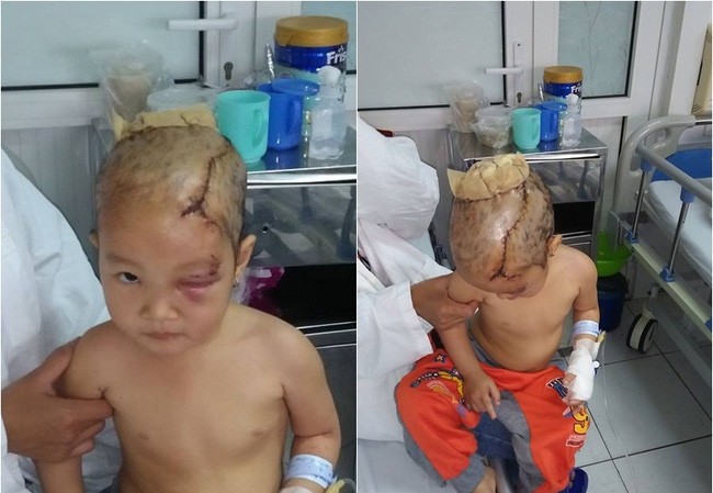 Bản tin 14H: Bé 3 tuổi bị chó cắn suýt mất mạng Bé Na bị thương nặng sau khi bị chó dữ tấn công.