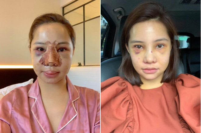 Lưu Đê Ly tung ảnh phẫu thuật biến dạng, công khai 'đập mặt' níu kéo tuổi xuân Nữ diễn viên đăng ảnh mặt sưng phồng sau dao kéo. Ảnh: FBNV.
