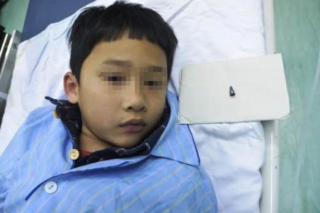Bé trai 7 tuổi nuốt đầu bút bi, mắc kẹt trong phế quản Bé Quân đã dần hồi phục sức khỏe.