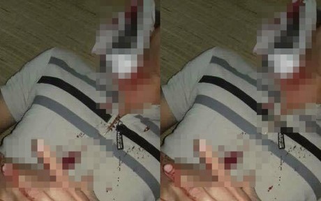 Chưa lấy được vật nghi đầu đạn trong cổ nạn nhân ở Hòa Bình Nam thanh niên bị dị vật găm vào cổ.