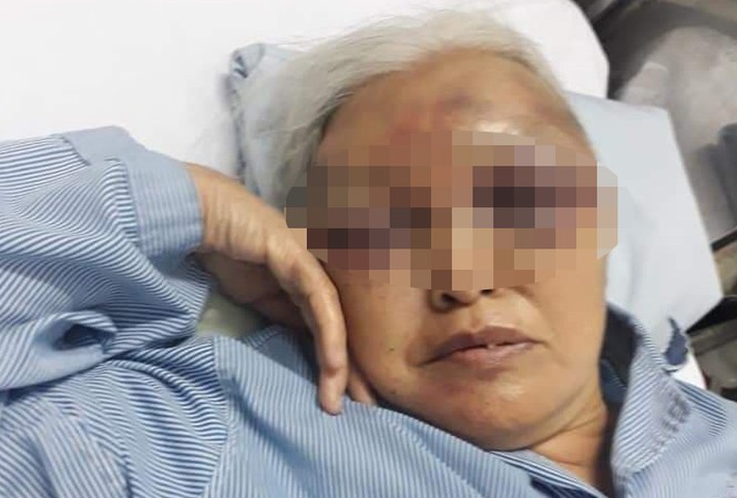 Con rể cũ đánh mẹ vợ nhập viện vì không được thăm con lúc rạng sáng Bà Chả đang điều trị trong bệnh viện.